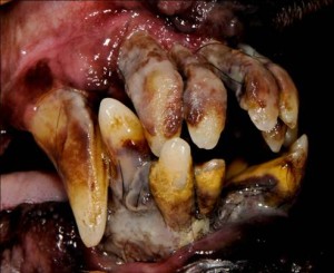 Acute stage 4 periodontal disease. Source: http://www.avdc.org/